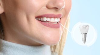 ایمپلنت دندان چیست؟ راهنمای جامع و کاربردی