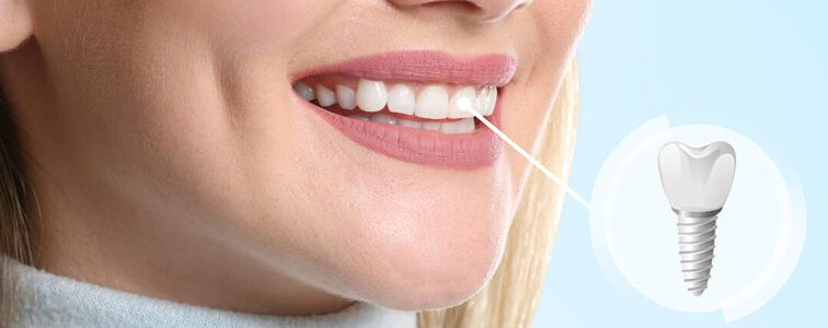 ایمپلنت دندان چیست؟ راهنمای جامع و کاربردی