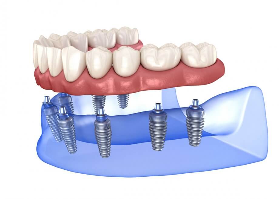 ایمپلنت دندان چیست؟ راهنمای جامع و کاربردی 3 ایمپلنت دندان چیست؟