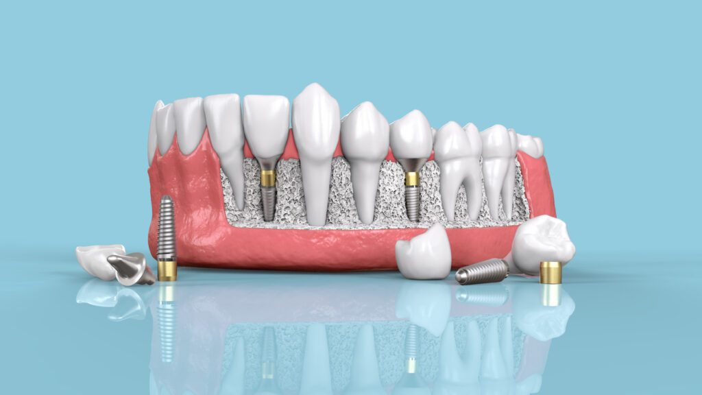 ایمپلنت دندان چیست؟ راهنمای جامع و کاربردی 5 عوارض ایمپلنت دندان