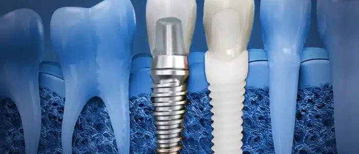 مزایا و معایب ایمپلنت دندان