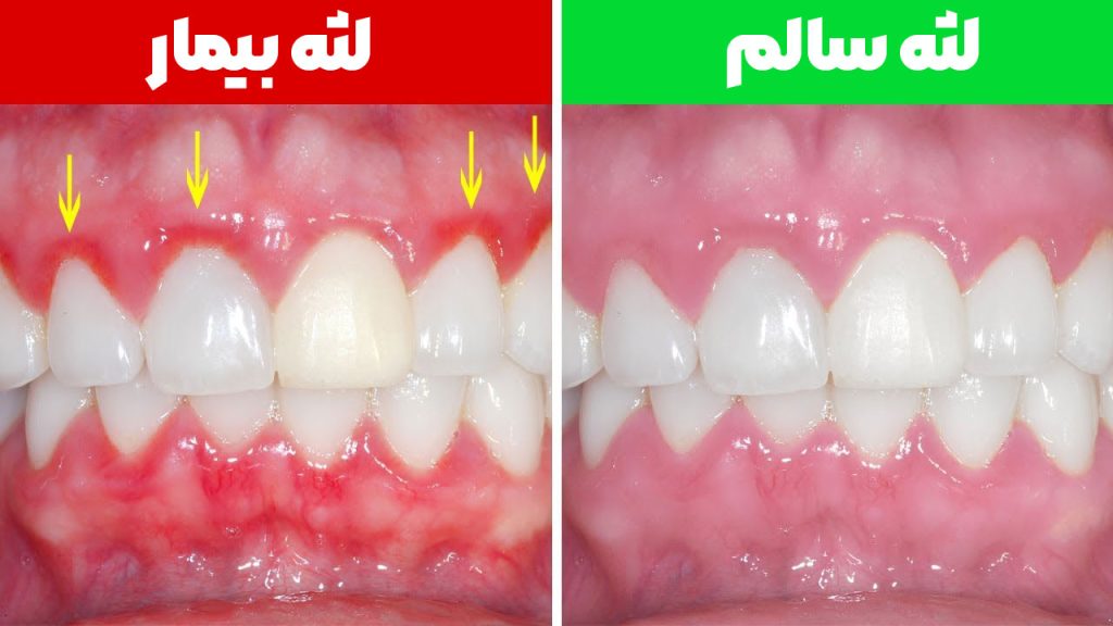 روش های مراقبت از لثه 2 تفاوت لثه سالم و بیمار