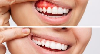 روش های مراقبت از لثه