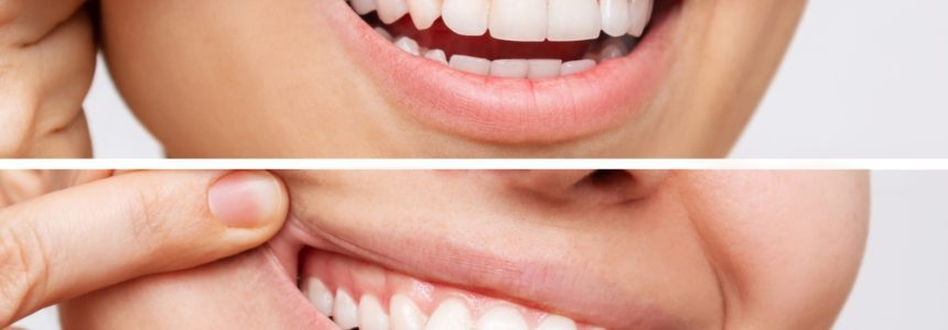 روش های مراقبت از لثه