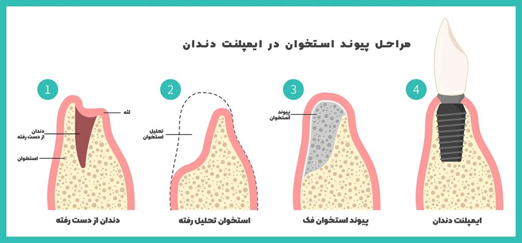 مراحل پیوند استخوان برای ایمپلنت