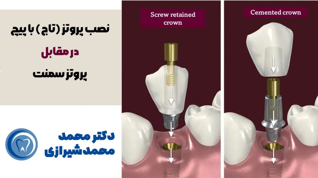 نصب پروتز بروی اباتمنت