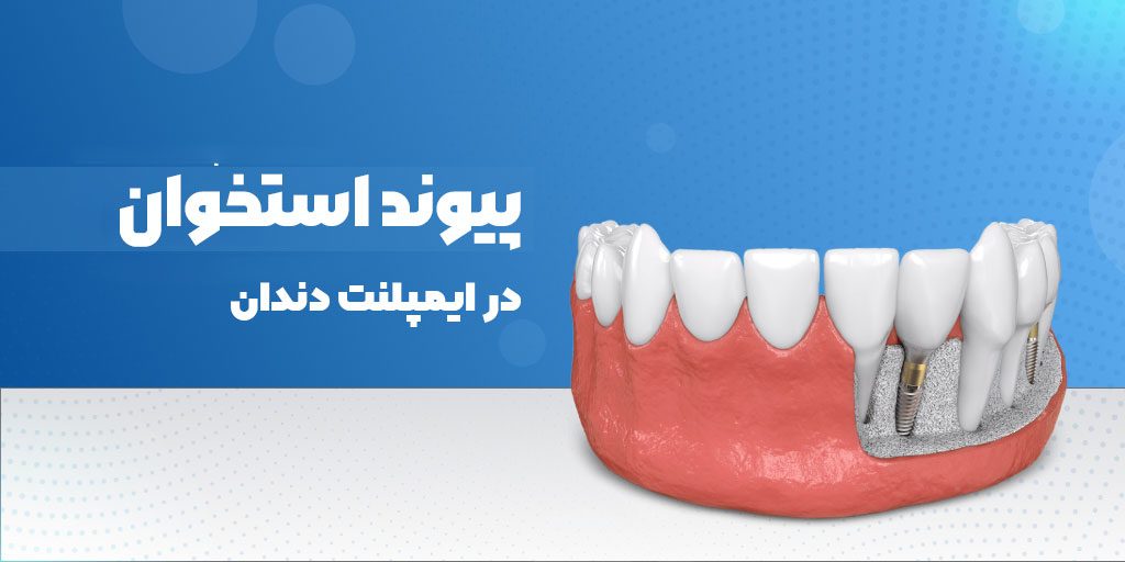 پیوند استخوان در ایمپلنت دندان چیست؟