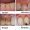 انواع مختلف سایش دندان‌ها و راه های جلوگیری
