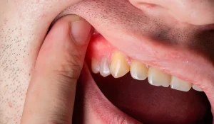 آبسه دندانی چیست و راه های مقابله با آن 3 درمان آبسه دندانی