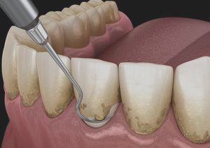 اهداف جراحی پریودنتال 