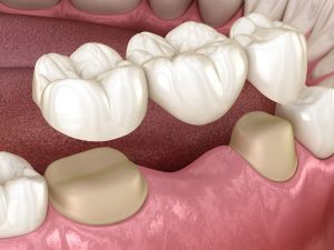 پل دندان چیست؟ تعریف و عملکرد پل دندان 2 پل دندان 2