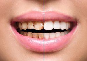 اهمیت جرمگیری دندان برای سلامت دهان و دندان ها 3 مزایای جرمگیری دندان