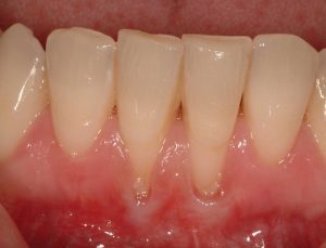 همه چیز درباره تحلیل لثه: علل، علائم و درمان 1 تحلیل لثه چیست؟