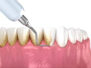 اهمیت جرمگیری دندان برای سلامت دهان و دندان ها 2 مراحل انجام جرمگیری دندان