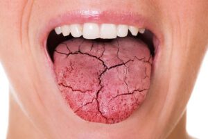نقش بزاق در سلامت دهان و دندان: چرا بزاق حیاتی است؟ 3 بزاق و جلوگیری از بیماری های دهانی