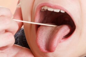 روش های پیشگیری از سنگ لوزه