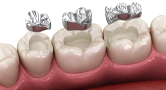 پرکردگی آمالگام