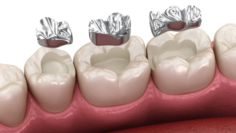 پرکردگی آمالگام
