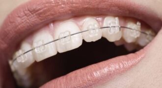 ارتودنسی سرامیکی