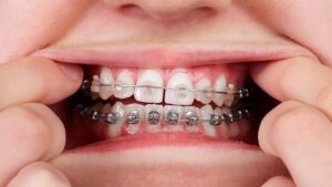 ارتودنسی سرامیکی چیست؟