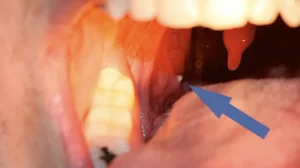 سنگ لوزه چیست؟