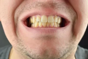 دلایل زرد شدن دندان ها و راه های جلوگیری از آن 3 درمان زرد شدن دندان ها