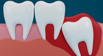 دندان عقل چیست